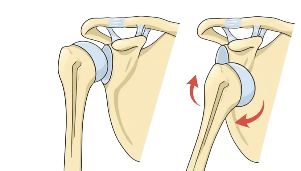 Luxation de l'épaule